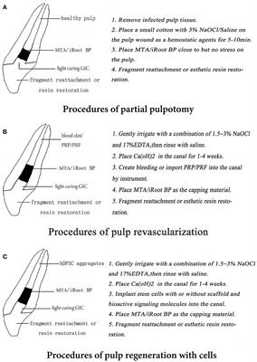 Regenerative Endodontic Procedures in Immature Permanent Teeth With Dental Trauma: Current Approaches and Challenges